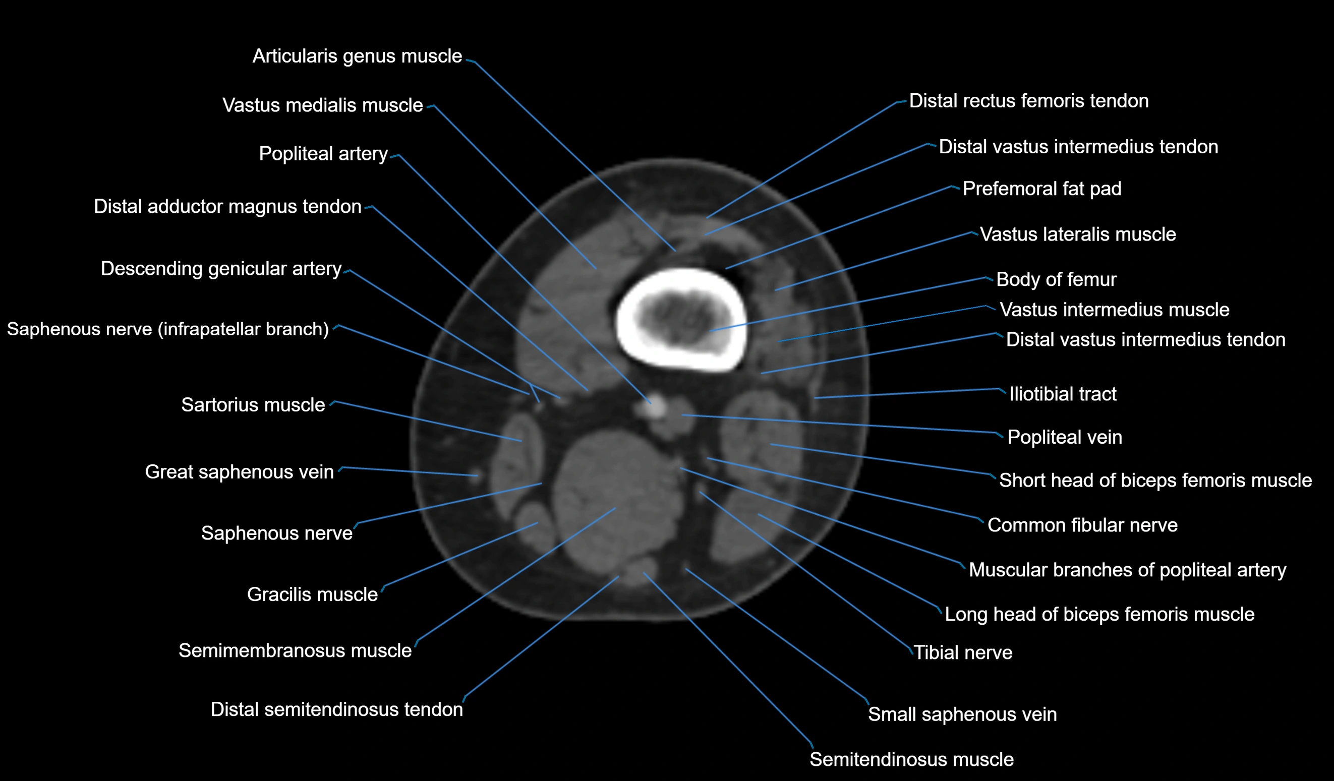 CT knee axial cross sectional anatomy labelled image-00008.webp